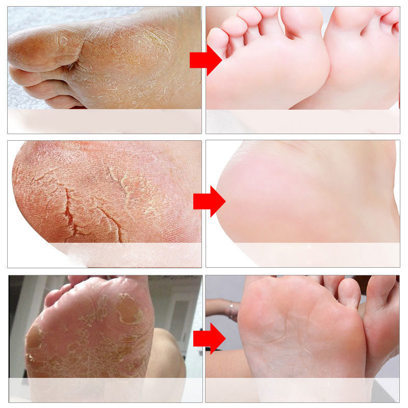 Masques exfoliants pour les pi - Foot Mask Peeling avis et prix